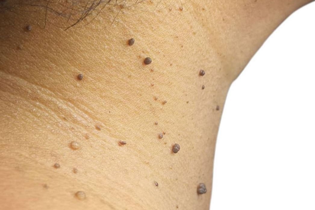 Beauty tips and secrets: 5 simple and effective ways to get rid skin tags.
